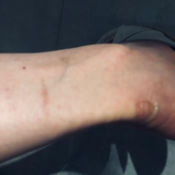 Yeni Alınan Nike Ayakkabı Kısa Sürede Ciddi Yara Ve Ağrıya Sebep Oldu