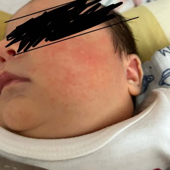 Mustela Yenidoğan Şampuanı Sonrası Bebeğimde Cilt Sorunları Ve Mağduriyet