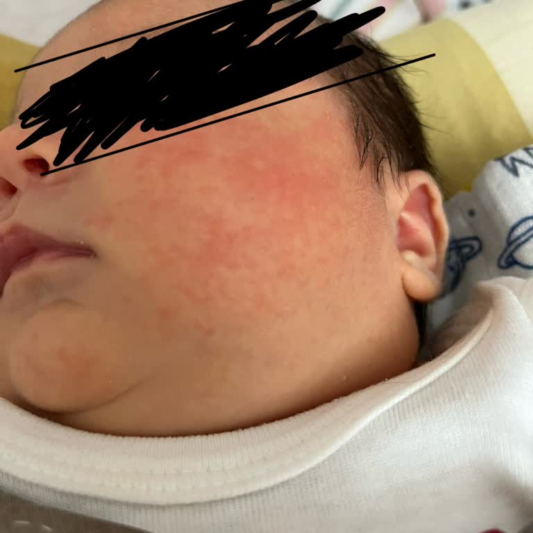 Mustela Yenidoğan Şampuanı Sonrası Bebeğimde Cilt Sorunları Ve Mağduriyet