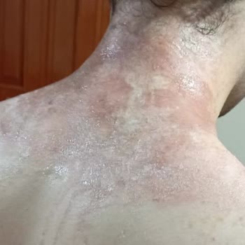 Tüy Dökücü Köpük Ciddi Yanık Ve Kalıcı İz Bıraktı Firma Sessiz Kaldı