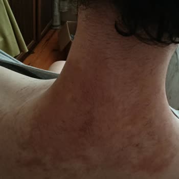 Tüy Dökücü Köpük Ciddi Yanık Ve Kalıcı İz Bıraktı Firma Sessiz Kaldı