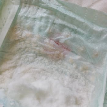 Prima Bebek Bezlerinde Tekrarlayan Kristalleşme Ve İlgisiz Müşteri Hizmeti