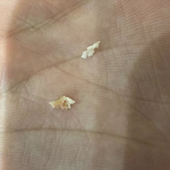 Diş Çekimi Sonrası Parça Bırakılması Ve Yanlış Bilgilendirme