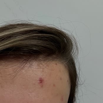 Bee Beauty Akne Yara Bandı Yüzümde Yanık Ve İz Bıraktı, Destek Alamıyorum