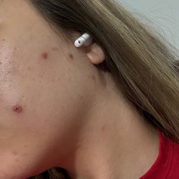 Bee Beauty Akne Yara Bandı Yüzümde Yanık Ve İz Bıraktı, Destek Alamıyorum