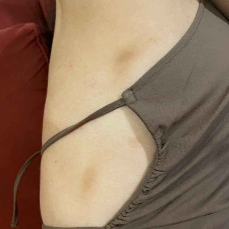 Sütyen Kullanımında Oluşan Yaralara Rağmen Çözüm Sunulmadı