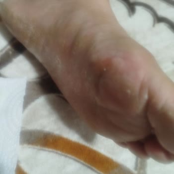 Ayak Maskesi Ciltte Ciddi Tahrişe Sebep Oldu