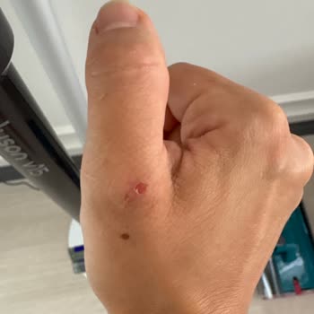 Dyson V15 Submarine Süpürge Tutma Kıskı Elimde Yaraya Sebep Oluyor, Acil Çözüm Bekliyorum