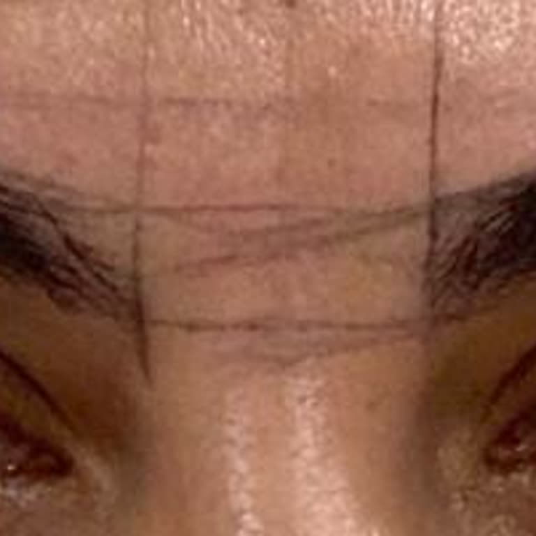 Kaş Alımı Sonrası Orantısız Ve Estetikten Uzak Sonuç, Hizmetten Memnun Kalmadım