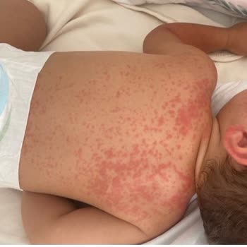 The X Belek Otel’de Hijyen Eksikliği Ve Sağlık Sorunları Yaşadık