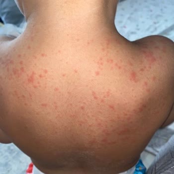 The X Belek Otel’de Hijyen Eksikliği Ve Sağlık Sorunları Yaşadık