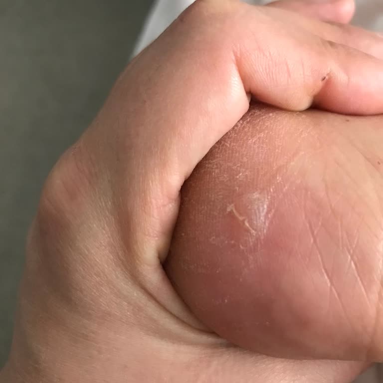 A101'den Aldığım Crocs Terlik Ayağımda Yaraya Sebep Oldu, İade Sürecinde Mağduriyet Yaşıyorum