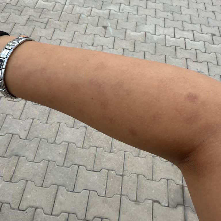 Epilasyon Sırasında Kollarım Yandı, Mağduriyetim Ciddiye Alınmıyor