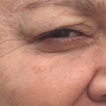 Göz Kapağı Ameliyatı Sonrası Sürekli Şişlik Ve İlgisizlik