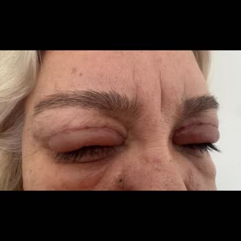 Göz Kapağı Ameliyatı Sonrası Sürekli Şişlik Ve İlgisizlik