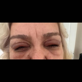 Göz Kapağı Ameliyatı Sonrası Sürekli Şişlik Ve İlgisizlik