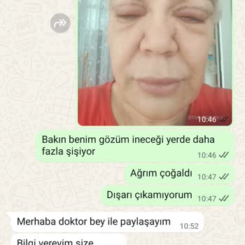 Göz Kapağı Ameliyatı Sonrası Sürekli Şişlik Ve İlgisizlik