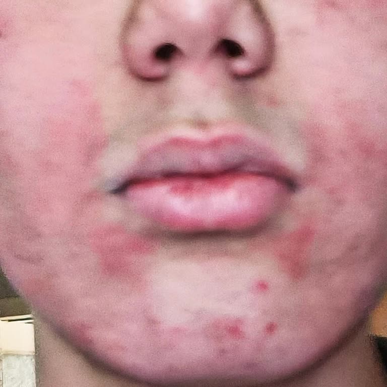 Veet para rostro: irritación y ardor tras primera aplicación