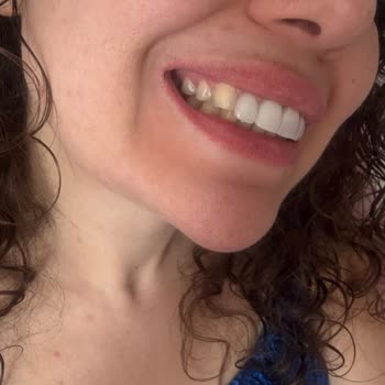 DM Klinik Kaplamalar 3. Gün Düştü