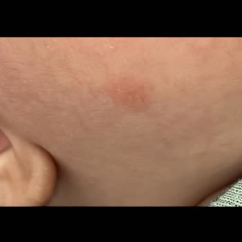 Mustela Yenidoğan Paketi Sonrası Bebeğimde Cilt Kızarıklığı Oluştu