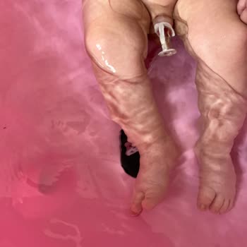 Yanlış Sünnet İşlemi Sonrası Çocuğum Tekrar Acı Çekti, Mağduriyetim Giderilsin