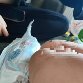 Molfix Bebek Bezinde Üretim Hatası Ve Cilt Tahrişi Şikayeti