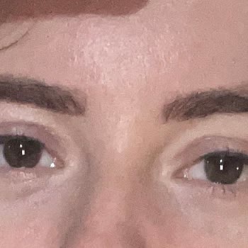 Göz Kapağı Ameliyatı Sonrası Kalıcı İz Ve Mağduriyet Yaşadım