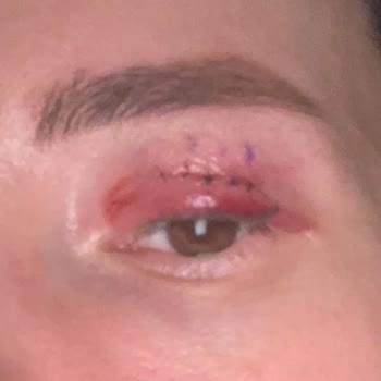 Göz Kapağı Ameliyatı Sonrası Kalıcı İz Ve Mağduriyet Yaşadım