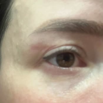 Göz Kapağı Ameliyatı Sonrası Kalıcı İz Ve Mağduriyet Yaşadım