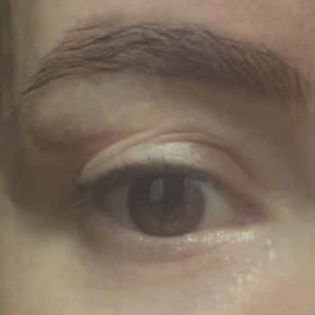 Göz Kapağı Ameliyatı Sonrası Kalıcı İz Ve Mağduriyet Yaşadım