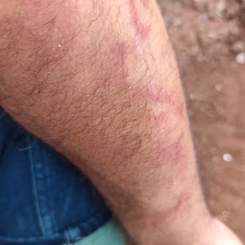 Enerji İçeceği Sonrası Yaşanan Ciddi Sağlık Sorunları Ve Mağduriyet