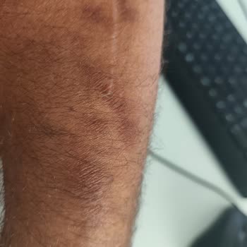 Enerji İçeceği Sonrası Yaşanan Ciddi Sağlık Sorunları Ve Mağduriyet