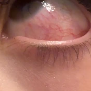 Yanlış Uygulama Sonrası Göz Sağlığı Sorunu ve İade Talebi