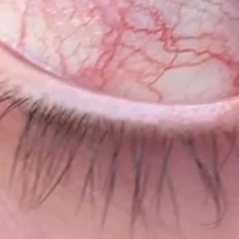 Yanlış Uygulama Sonrası Göz Sağlığı Sorunu ve İade Talebi