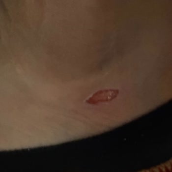 Aldığım Ayakkabı Ayağımda Yaralara Sebep Oldu, İade Talebim Reddedildi