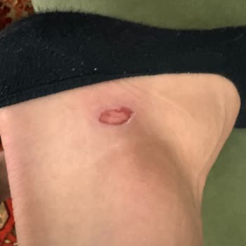 Aldığım Ayakkabı Ayağımda Yaralara Sebep Oldu, İade Talebim Reddedildi