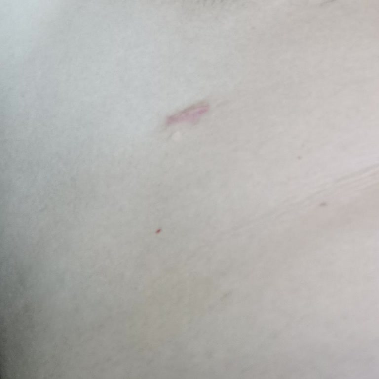 Jinekomasti Ameliyatı Sonrası İz Ve İletişimsizlik Mağduriyeti