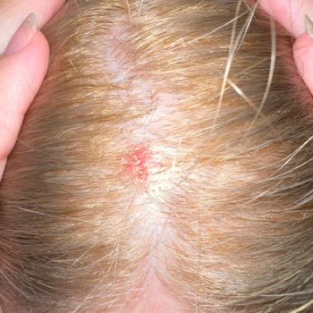 Schwarzkopf Palette Gave Me Severe Scalp Burn