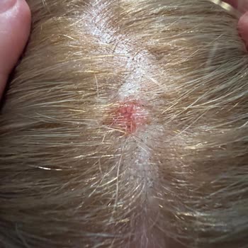 Schwarzkopf Palette Gave Me Severe Scalp Burn