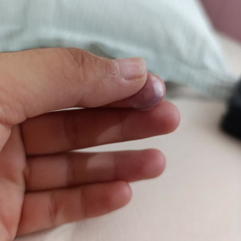 Hasarlı Lens Nedeniyle Gözümde Ciddi Sağlık Sorunu Yaşadım