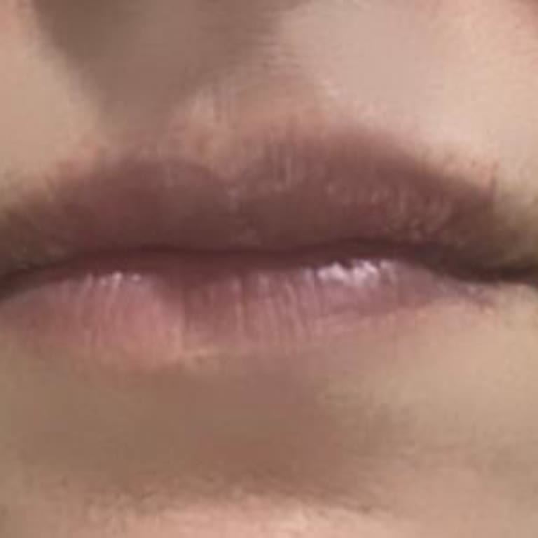 Liva Kliniği'nde Botoks Ve Dolgu Sonrası Memnuniyetsizlik Ve Ücret İadesi Talebi