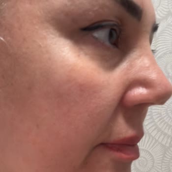 Burun Ameliyatı Sonrası Yaşadığım Büyük Hayal Kırıklığı