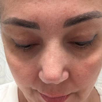 Burun Ameliyatı Sonrası Yaşadığım Büyük Hayal Kırıklığı