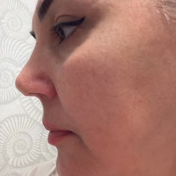 Burun Ameliyatı Sonrası Yaşadığım Büyük Hayal Kırıklığı