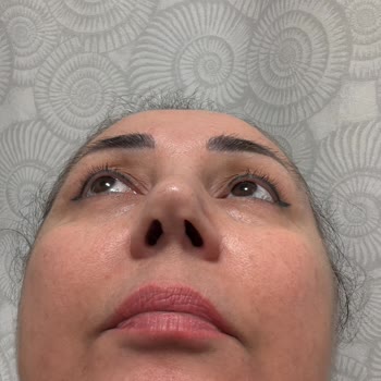 Burun Ameliyatı Sonrası Yaşadığım Büyük Hayal Kırıklığı