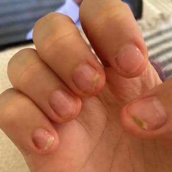 Ataşehir Nail & Beauty Protez Tırnak Sonrası Oluşan Mantar