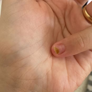 Ataşehir Nail & Beauty Protez Tırnak Sonrası Oluşan Mantar