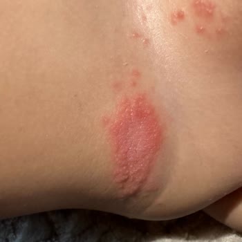 Molfix Bebek Bezi Nedeniyle Bebeğimde Uzun Süredir Geçmeyen Pişik Ve Mantar Sorunu