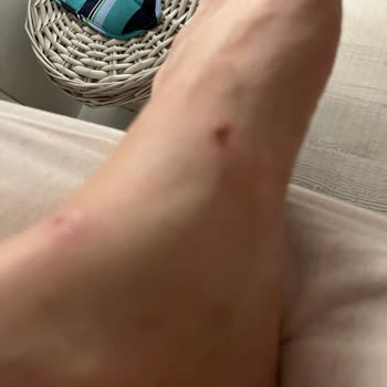 Yeni Alınan Sandaletin Kısa Sürede Ayakta Yara Yapması