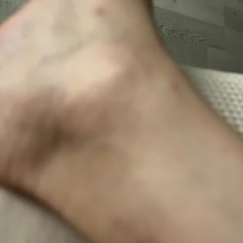 Yeni Alınan Sandaletin Kısa Sürede Ayakta Yara Yapması